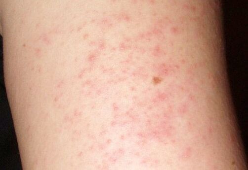 Itchy rash-symptoms of the presence of worms in the liver